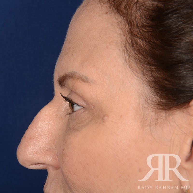 Browlift Before & After Gallery - Patient 201278 - Image 5