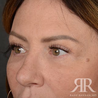 Browlift Before & After Gallery - Patient 201278 - Image 4