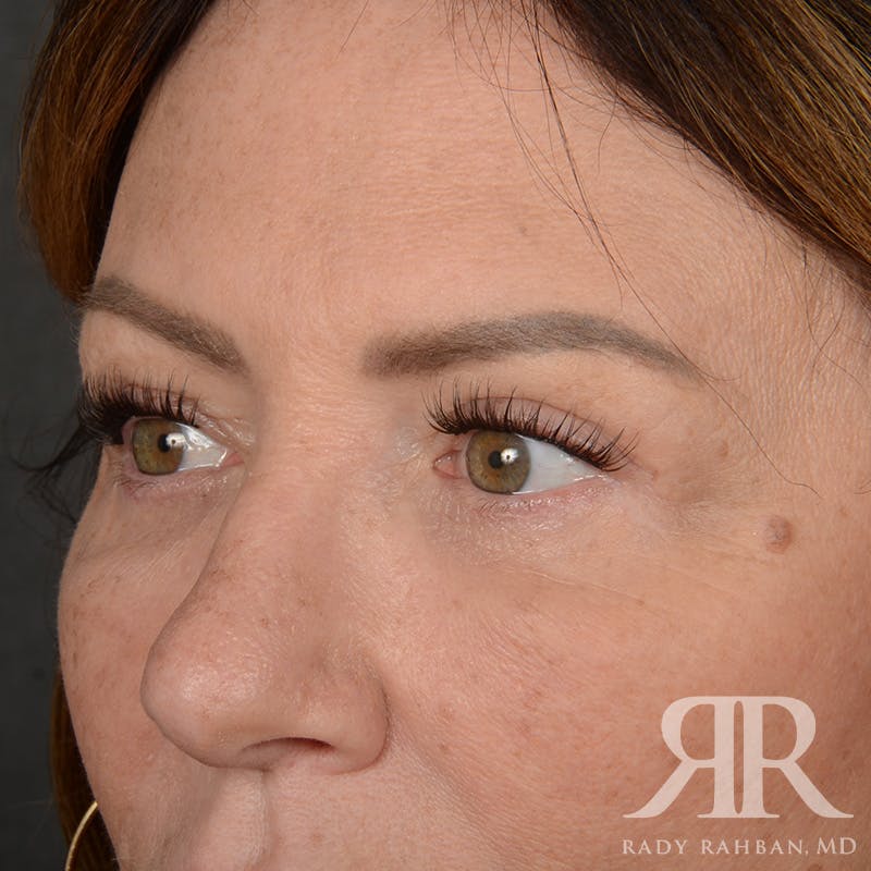 Browlift Before & After Gallery - Patient 201278 - Image 4