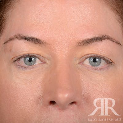 Browlift Before & After Gallery - Patient 236098 - Image 1