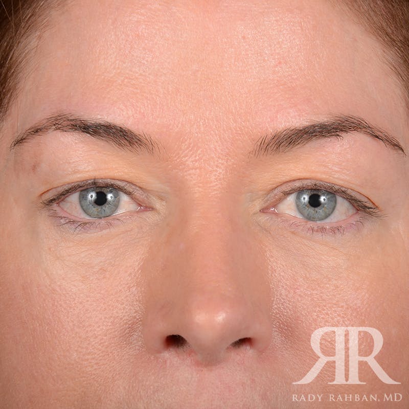 Browlift Before & After Gallery - Patient 236098 - Image 1