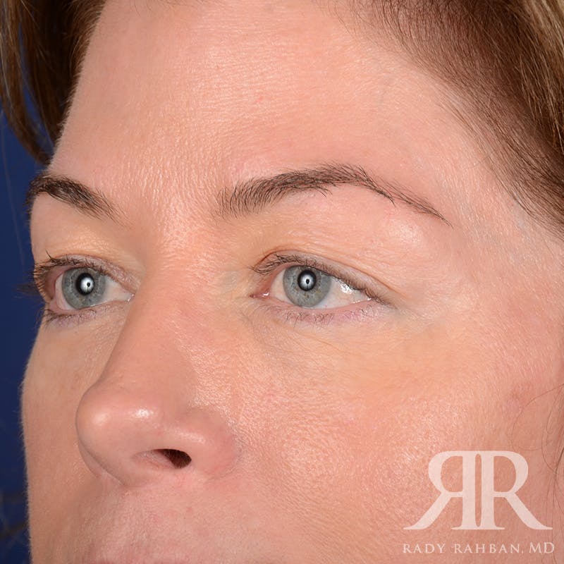 Browlift Before & After Gallery - Patient 236098 - Image 3