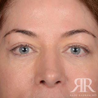 Browlift Before & After Gallery - Patient 236098 - Image 2