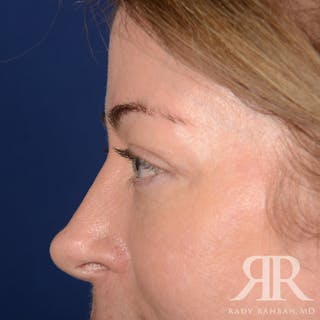 Browlift Before & After Gallery - Patient 236098 - Image 6