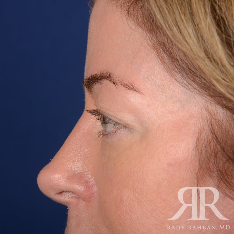 Browlift Before & After Gallery - Patient 236098 - Image 5