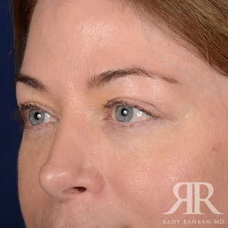 Browlift Before & After Gallery - Patient 236098 - Image 4