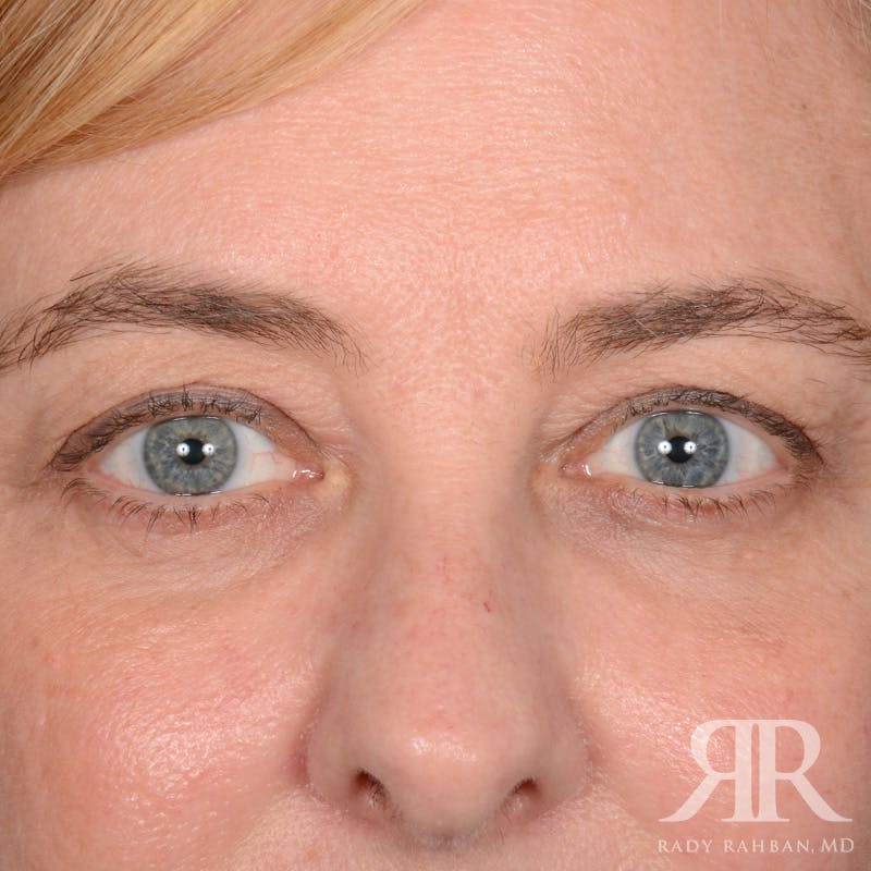 Eyelid Surgery Before & After Gallery - Patient 142114 - Image 1