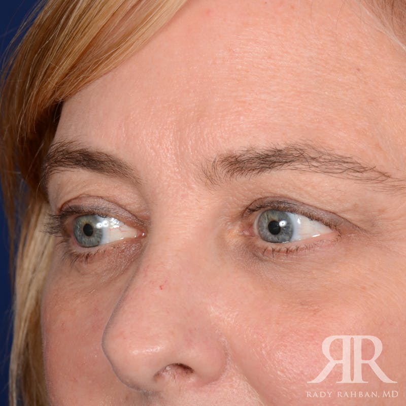 Eyelid Surgery Before & After Gallery - Patient 142114 - Image 3