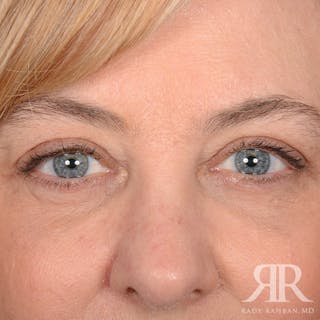 Eyelid Surgery Before & After Gallery - Patient 142114 - Image 2