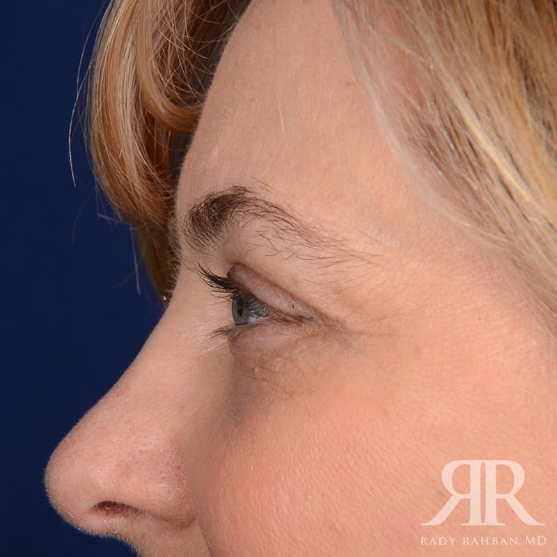 Eyelid Surgery Before & After Gallery - Patient 142114 - Image 6