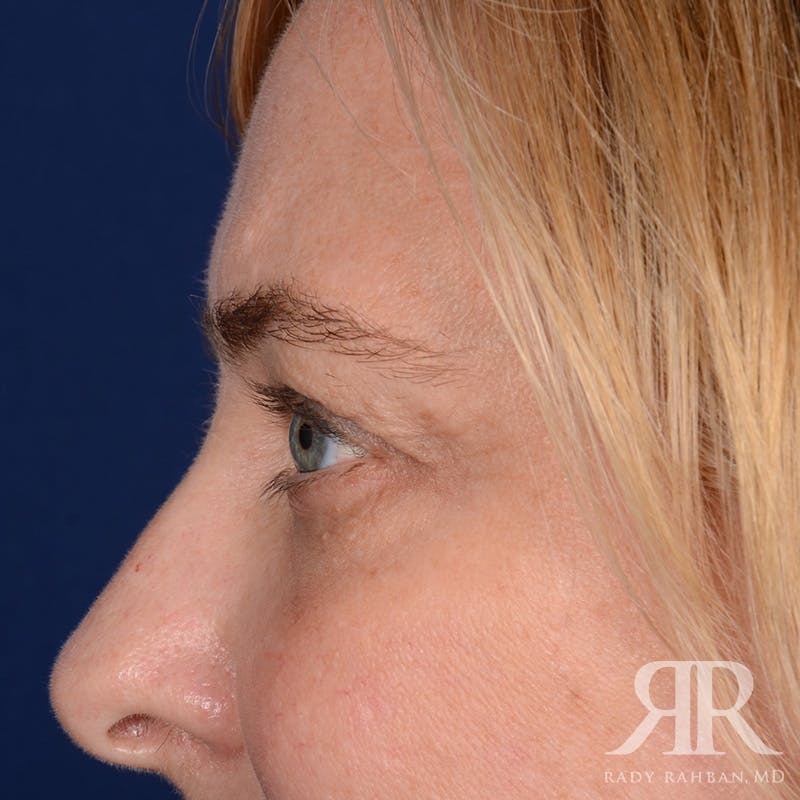 Eyelid Surgery Before & After Gallery - Patient 142114 - Image 5