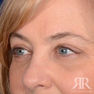 Eyelid Surgery Before & After Gallery - Patient 142114 - Image 4