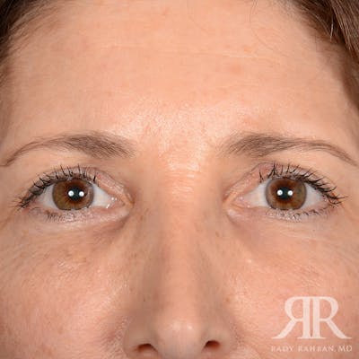 Eyelid Surgery Before & After Gallery - Patient 675646 - Image 1