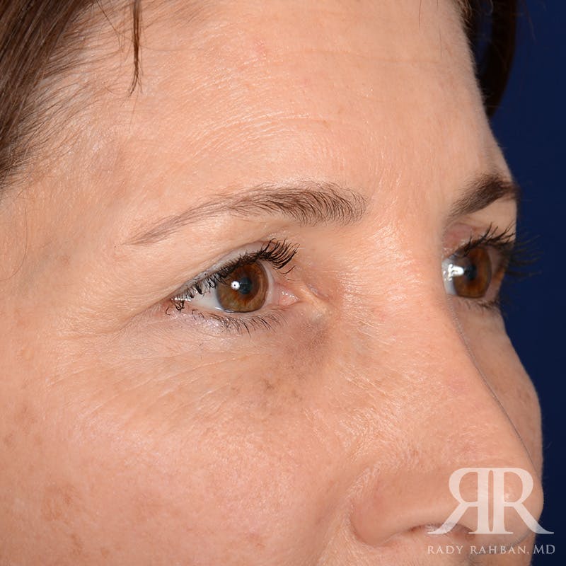 Eyelid Surgery Before & After Gallery - Patient 675646 - Image 3