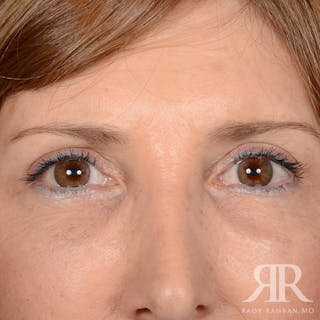 Eyelid Surgery Before & After Gallery - Patient 675646 - Image 2