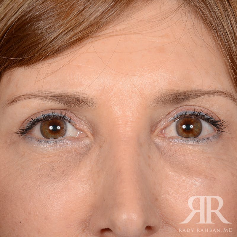 Eyelid Surgery Before & After Gallery - Patient 675646 - Image 2