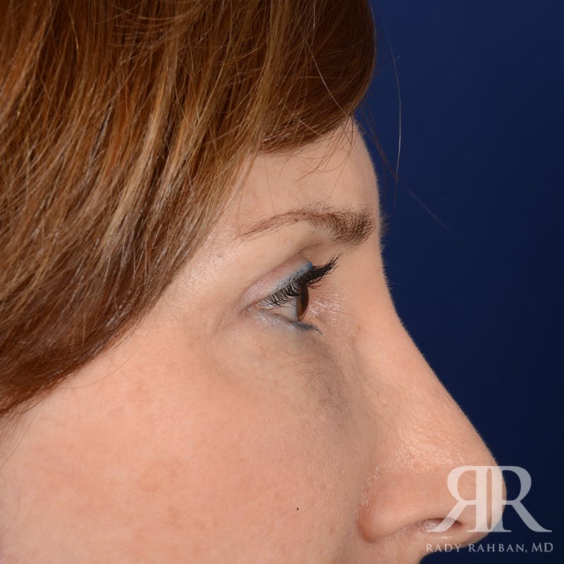 Eyelid Surgery Before & After Gallery - Patient 675646 - Image 6