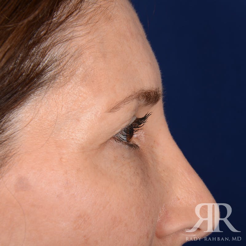 Eyelid Surgery Before & After Gallery - Patient 675646 - Image 5