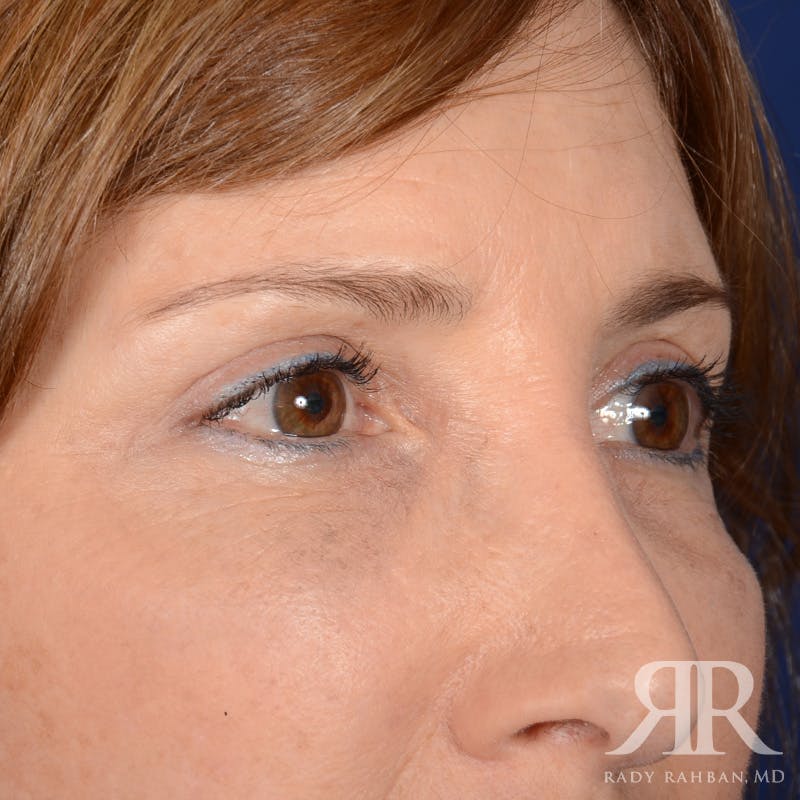 Eyelid Surgery Before & After Gallery - Patient 675646 - Image 4