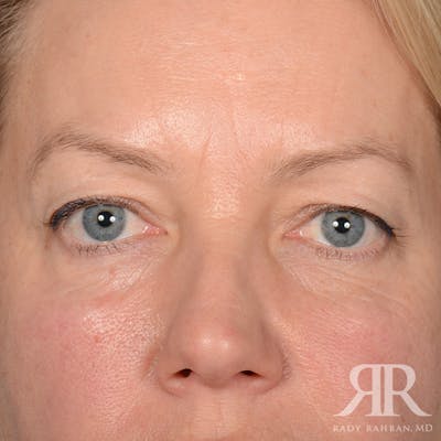 Eyelid Surgery Before & After Gallery - Patient 240878 - Image 1