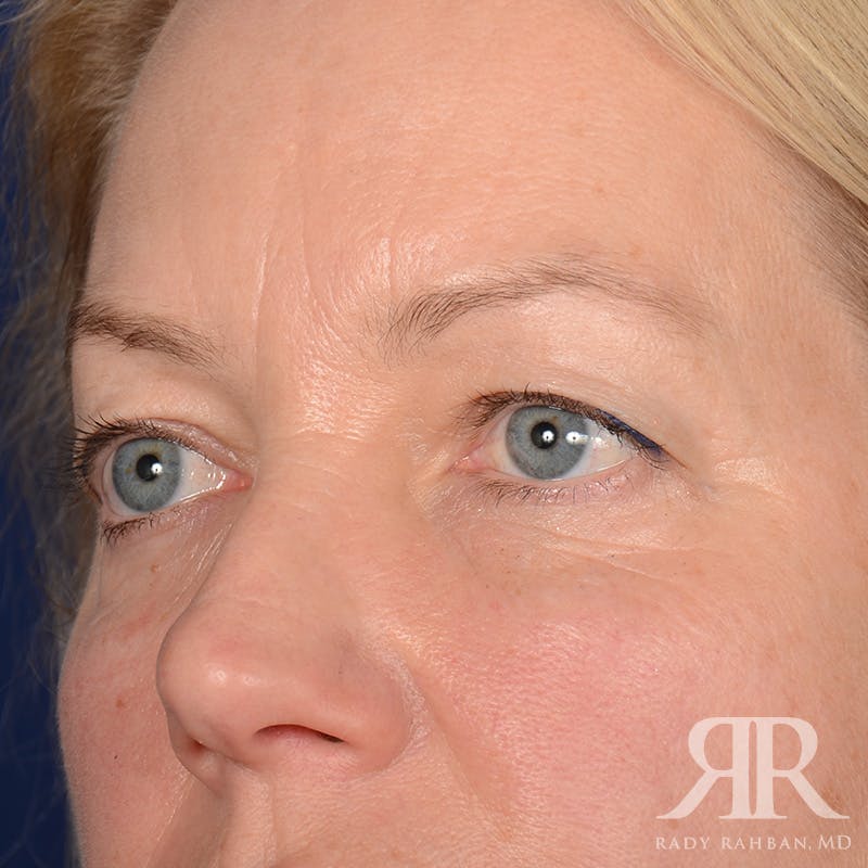Eyelid Surgery Before & After Gallery - Patient 240878 - Image 3