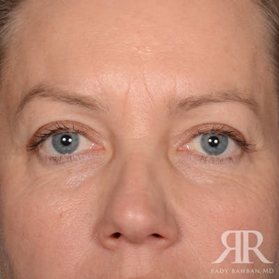 Eyelid Surgery Before & After Gallery - Patient 240878 - Image 2