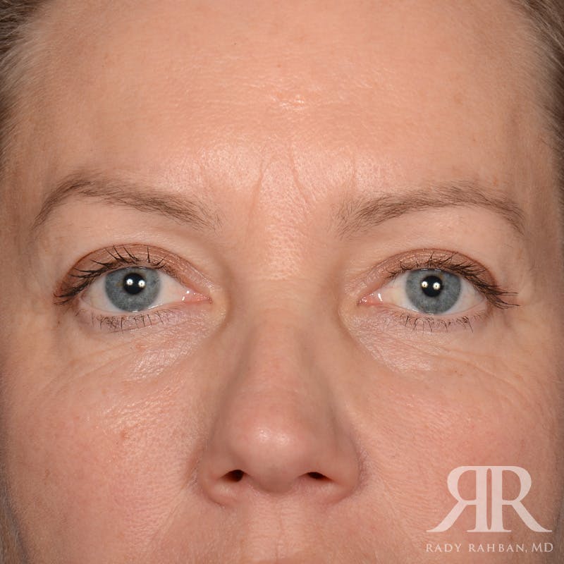 Eyelid Surgery Before & After Gallery - Patient 240878 - Image 2