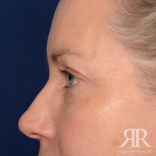 Eyelid Surgery Before & After Gallery - Patient 240878 - Image 6