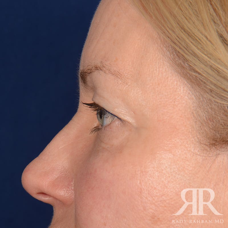 Eyelid Surgery Before & After Gallery - Patient 240878 - Image 5