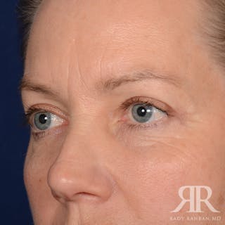 Eyelid Surgery Before & After Gallery - Patient 240878 - Image 4