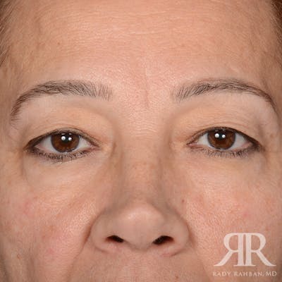 Eyelid Surgery Before & After Gallery - Patient 335001 - Image 1