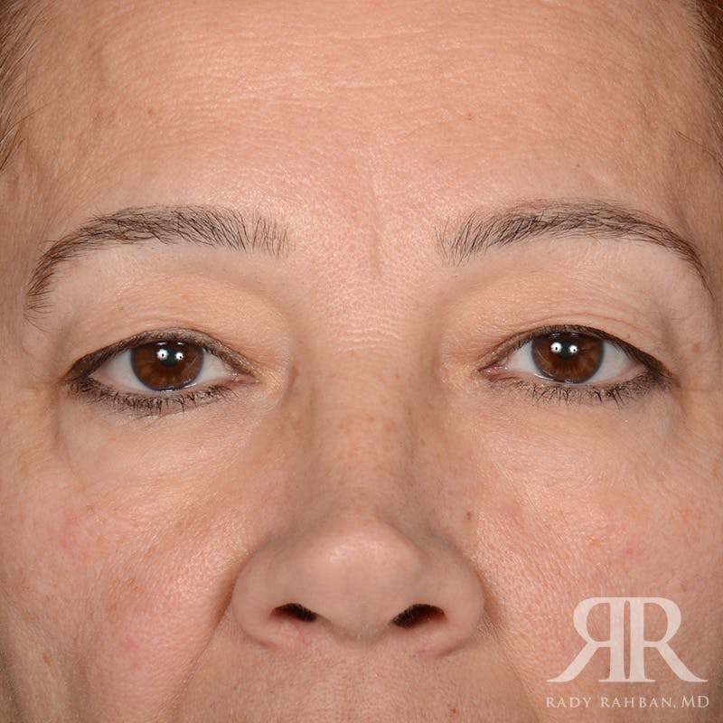 Eyelid Surgery Before & After Gallery - Patient 335001 - Image 1