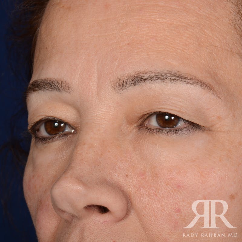 Eyelid Surgery Before & After Gallery - Patient 335001 - Image 3