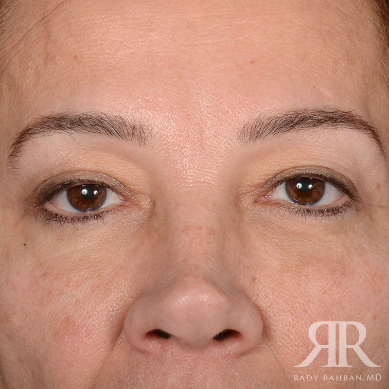Eyelid Surgery Before & After Gallery - Patient 335001 - Image 2