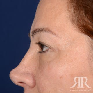 Eyelid Surgery Before & After Gallery - Patient 335001 - Image 6
