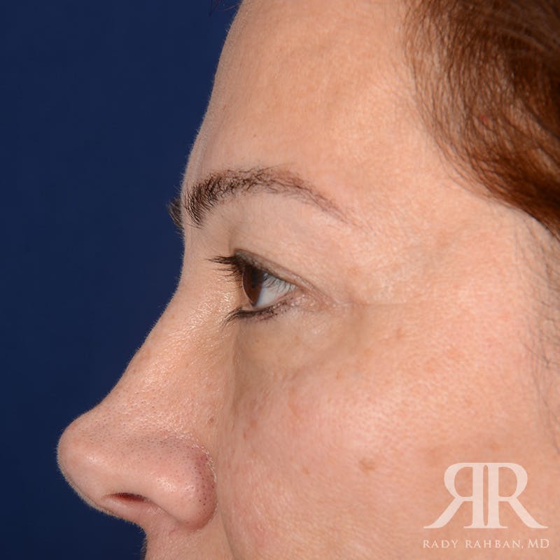 Eyelid Surgery Before & After Gallery - Patient 335001 - Image 6