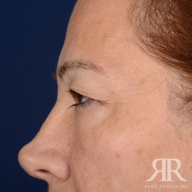 Eyelid Surgery Before & After Gallery - Patient 335001 - Image 5