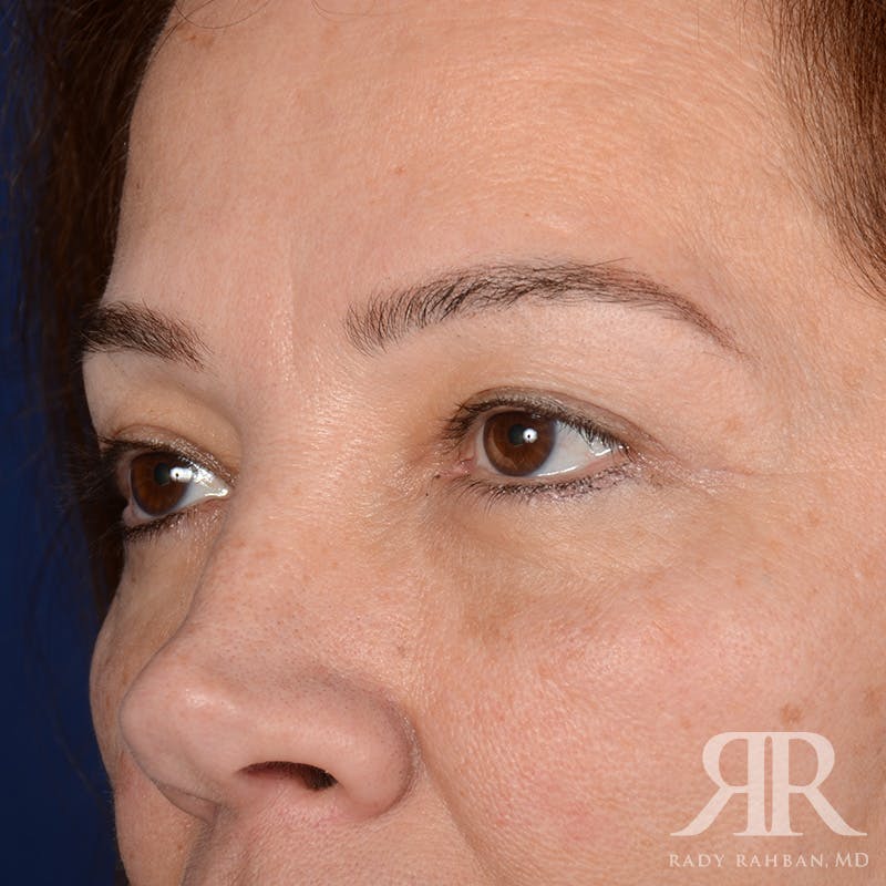 Eyelid Surgery Before & After Gallery - Patient 335001 - Image 4