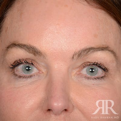 Eyelid Surgery Before & After Gallery - Patient 308003 - Image 1