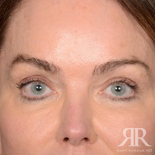 Eyelid Surgery Before & After Gallery - Patient 308003 - Image 2