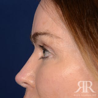 Eyelid Surgery Before & After Gallery - Patient 308003 - Image 6