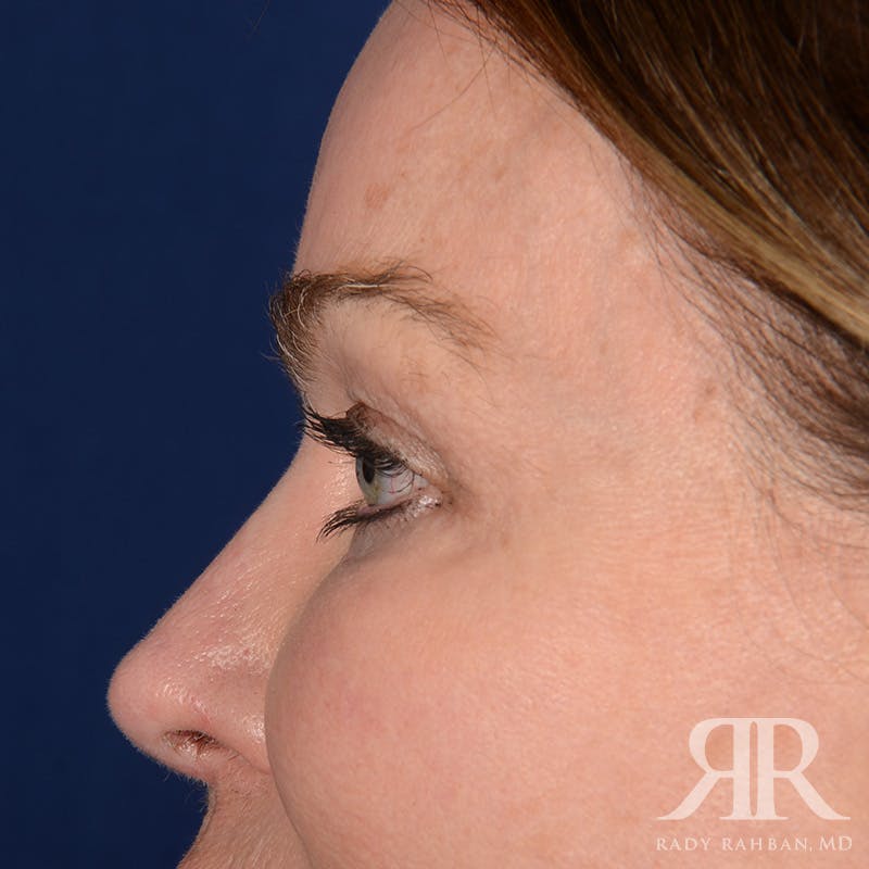 Eyelid Surgery Before & After Gallery - Patient 308003 - Image 5
