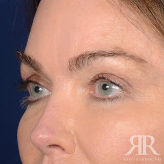 Eyelid Surgery Before & After Gallery - Patient 308003 - Image 4