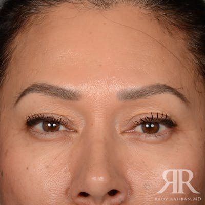 Eyelid Surgery Before & After Gallery - Patient 355350 - Image 1
