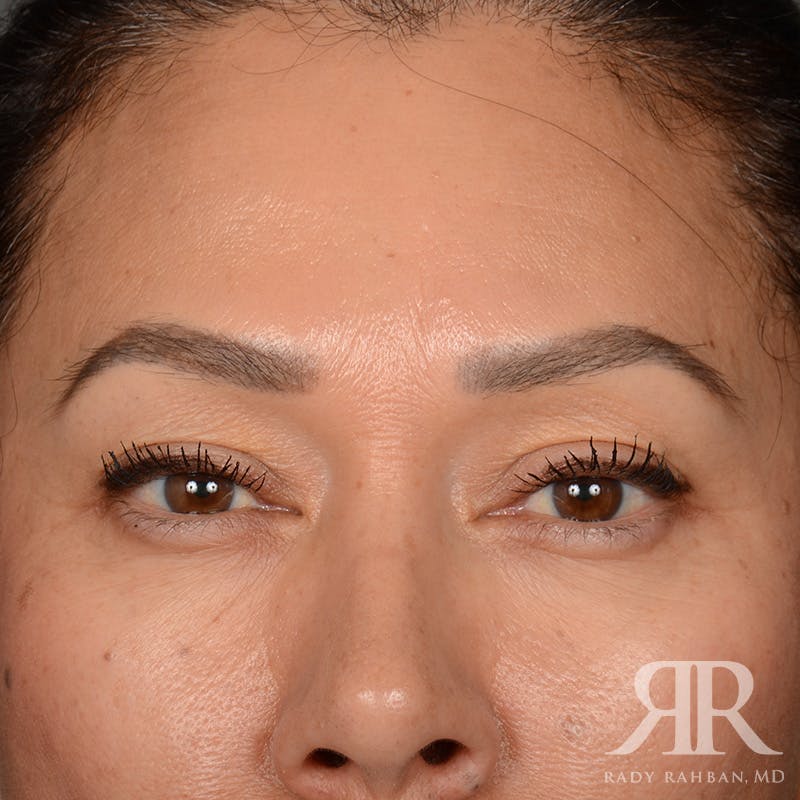 Eyelid Surgery Before & After Gallery - Patient 355350 - Image 1