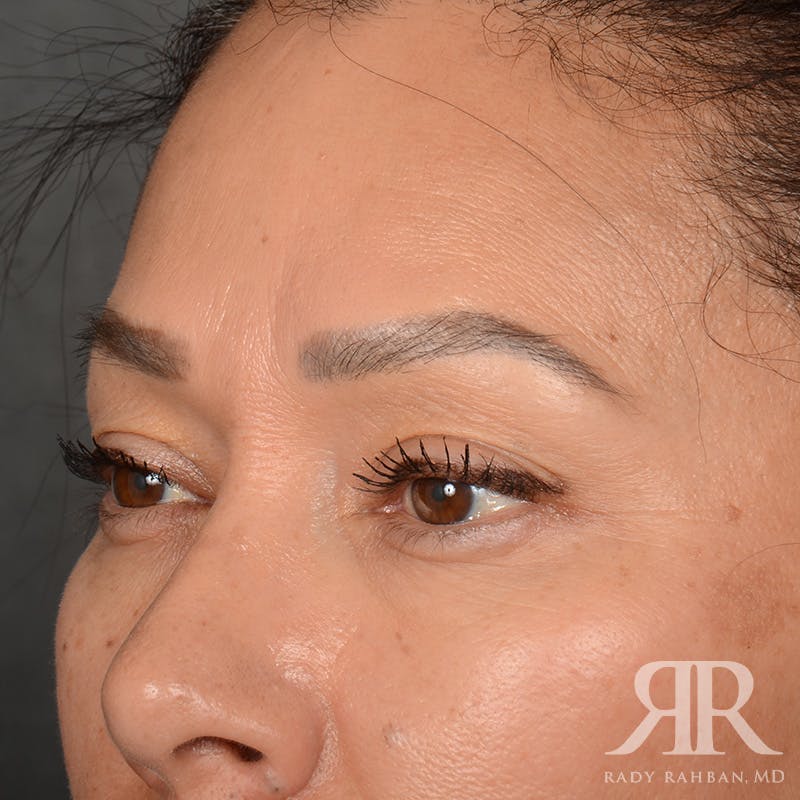 Eyelid Surgery Before & After Gallery - Patient 355350 - Image 3