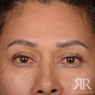 Eyelid Surgery Before & After Gallery - Patient 355350 - Image 2