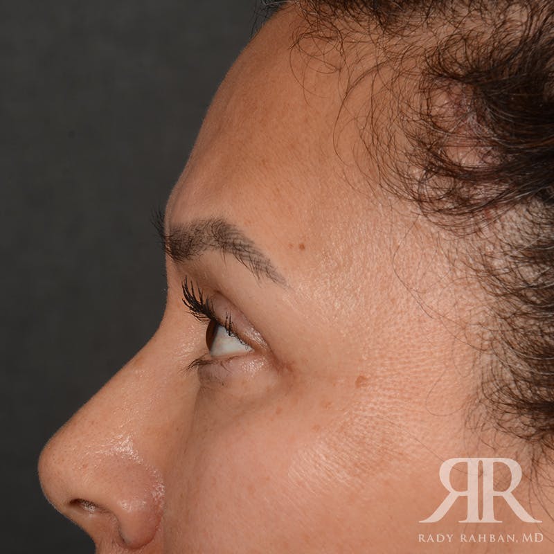 Eyelid Surgery Before & After Gallery - Patient 355350 - Image 6