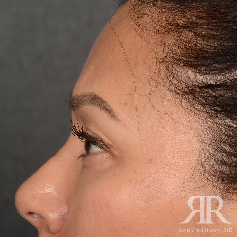 Eyelid Surgery Before & After Gallery - Patient 355350 - Image 5