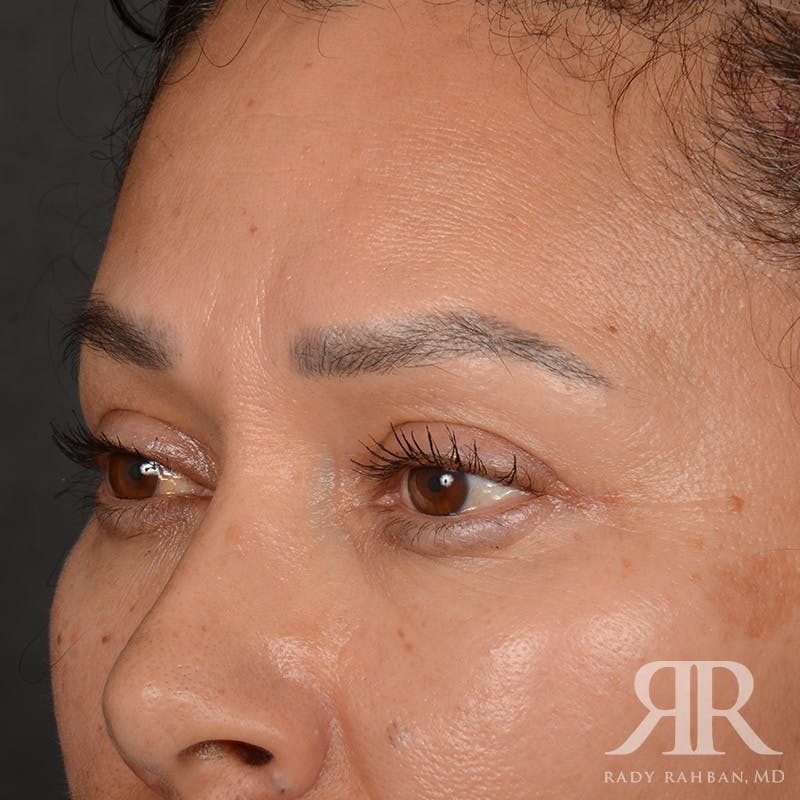 Eyelid Surgery Before & After Gallery - Patient 355350 - Image 4